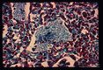Pneumonia. Higher magnification of infected lung stained by Wheatly modification of trichrome stain for stools showing 