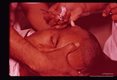 Excision of nodule.