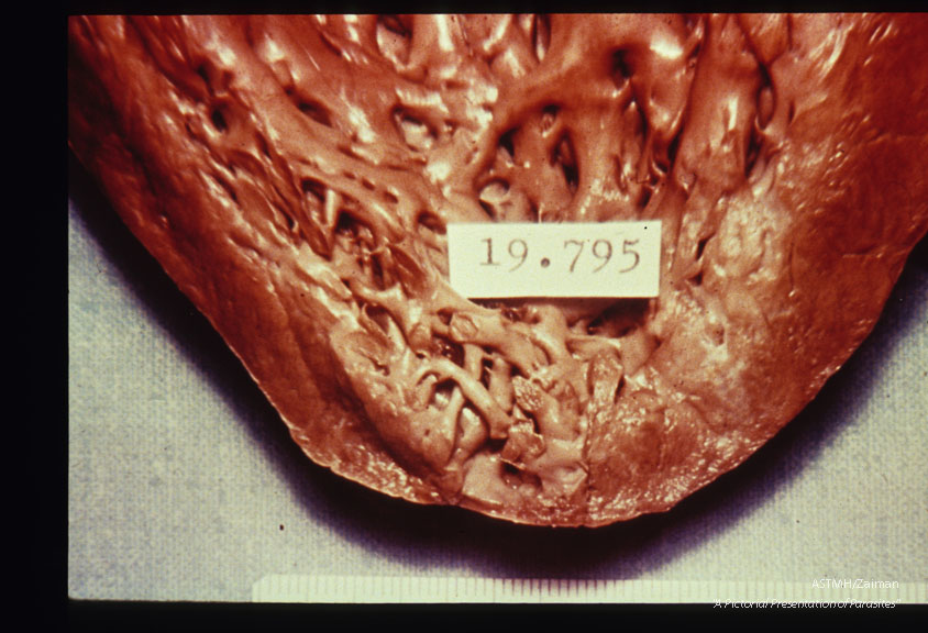 Multiple specimens showing aneurysmal dilatation and thinning of the apical myocardium, plus marked concentric muscular hypertrophy.