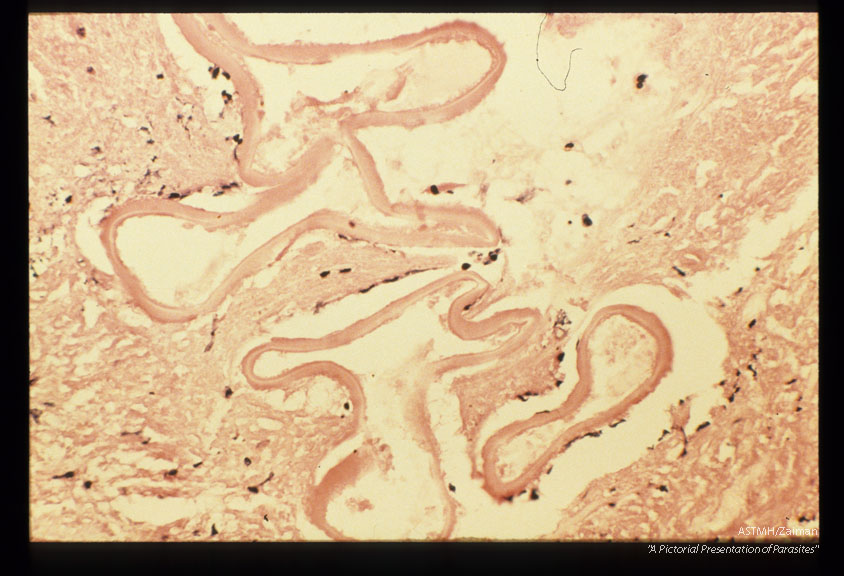 Gross and microscopic photos of human liver from Minnesota where about one half of the red foxes are infected.