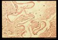 Gross and microscopic photos of human liver from Minnesota where about one half of the red foxes are infected.