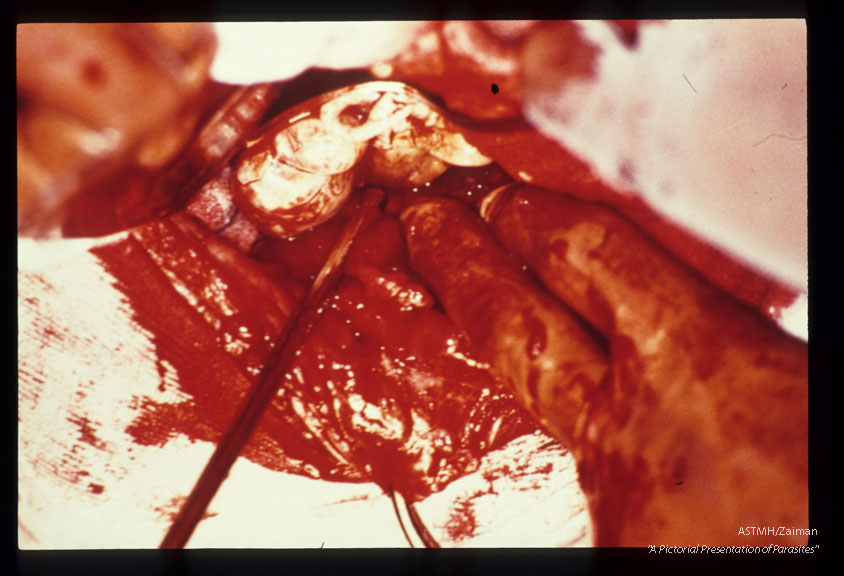 A 26 year old Italian male presented with jaundice due to biliary tree obstructions by daughter cysts of Echinoccocus granulosus. Picture sequence of operative dissection. Removal of cysts, placement of multiple drains and creation of several anastomoses were required to ensure proper biliary drainage and to prevent bile peritonitis.