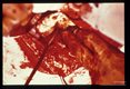 A 26 year old Italian male presented with jaundice due to biliary tree obstructions by daughter cysts of Echinoccocus granulosus. Picture sequence of operative dissection. Removal of cysts, placement of multiple drains and creation of several anastomoses were required to ensure proper biliary drainage and to prevent bile peritonitis.