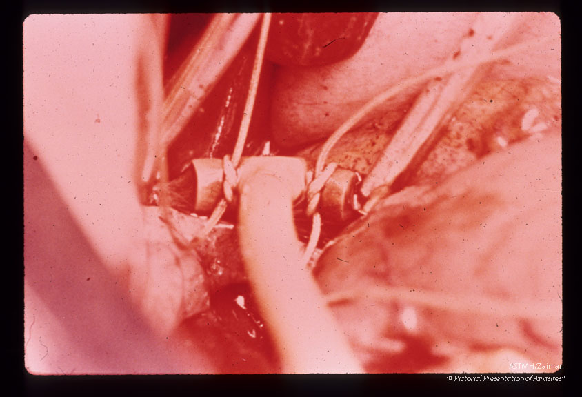 Mobilization of hepatic vein and insertion of tubing leading to bypass filter.