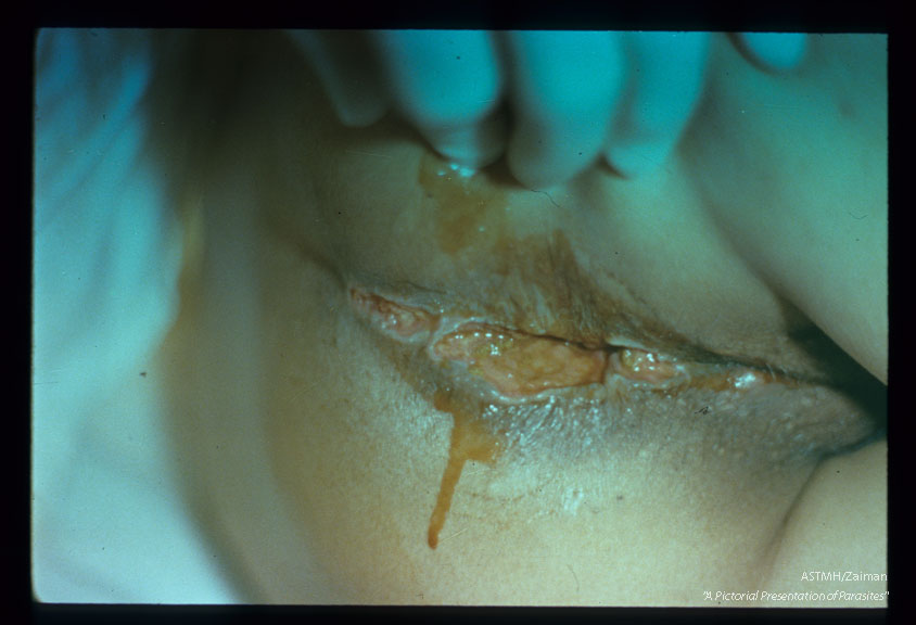 Perirectal muco-cutaneous amebiasis.