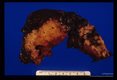 Gross and microscopic photos of human liver from Minnesota where about one half of the red foxes are infected.