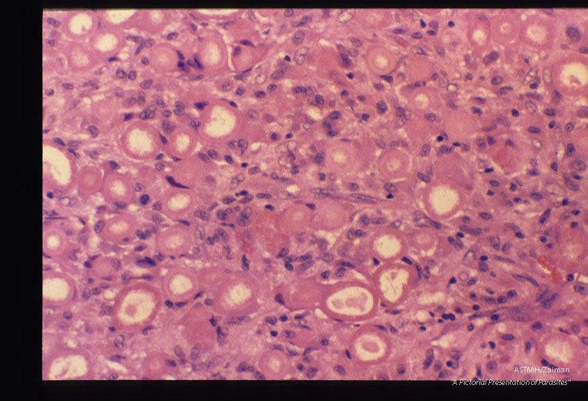 These slides are from a second such case. Reference Amer. Journ. Surg. Path. '11(8): 598-605,1987.