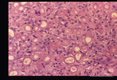These slides are from a second such case. Reference Amer. Journ. Surg. Path. '11(8): 598-605,1987.