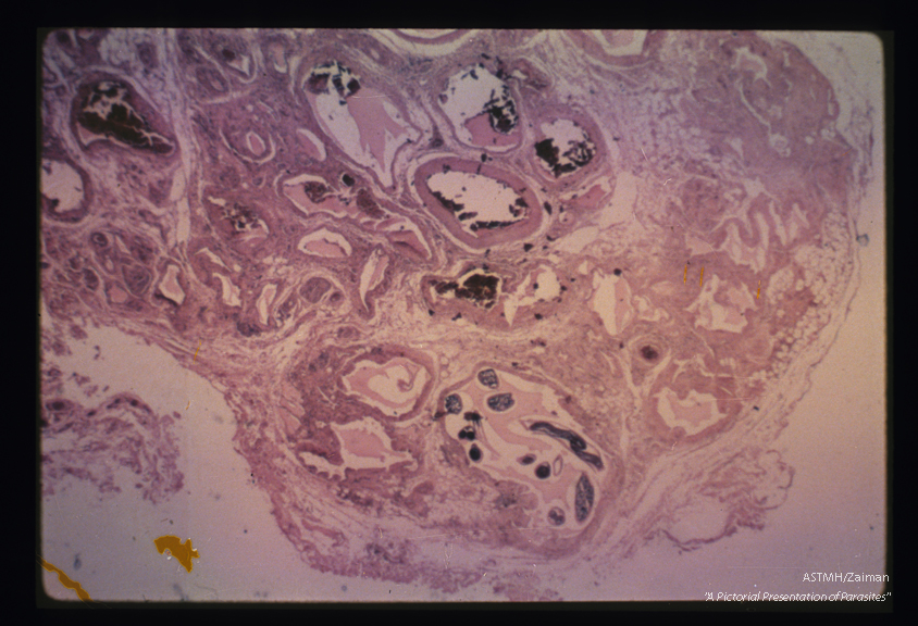 Adults in a lymphatic duct of the epididymis. The parasite presents as dark blue material in the upper portion of the picture.