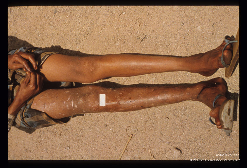 Fourteen year old boy with sowda (localized onchocerciasis) of the right leg. The leg is darker and swollen and there is a papular and vesicular dermatitis, Wadi Barakani in the south of the Yemen Arab Republic.