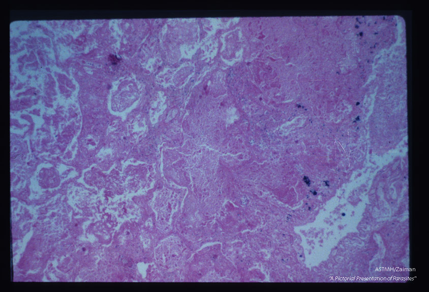 Wall of pulmonary abscess.