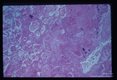 Wall of pulmonary abscess.