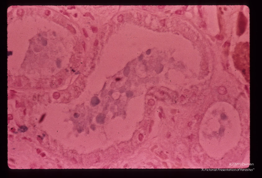 A 69 year old white male received 10 pints of blood shortly before,  during and after gastrectomy for a   benign gastric ulcer.    One of the donors,  a previously infected veteran of the Viet Nam war, registered at the blood bank under a false name and addrer Approximately four weeks after the surgery the patient developed a fatal case of falciparum malaria.  Section of kidney stained to demonstrate iron in lumen and epithelial cells.