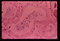 A 69 year old white male received 10 pints of blood shortly before,  during and after gastrectomy for a   benign gastric ulcer.    One of the donors,  a previously infected veteran of the Viet Nam war, registered at the blood bank under a false name and addrer Approximately four weeks after the surgery the patient developed a fatal case of falciparum malaria.  Section of kidney stained to demonstrate iron in lumen and epithelial cells.