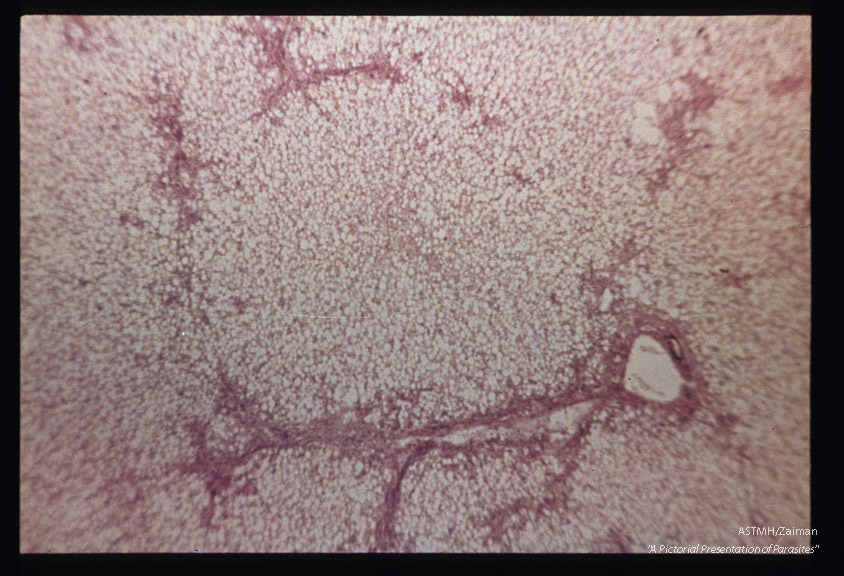 Hematoxylin-eosin stained section of above liver showing fatty degeneration of parenchymatous cells.