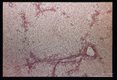 Hematoxylin-eosin stained section of above liver showing fatty degeneration of parenchymatous cells.