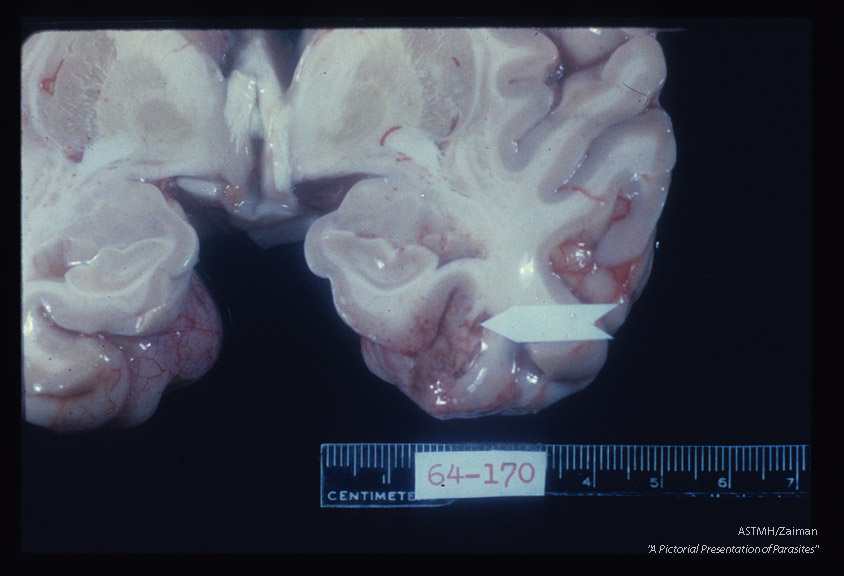 Amoebic abscess of cerebrum.