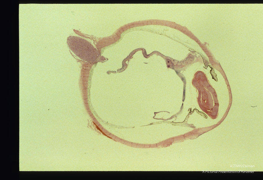 Retinal detachment in a human eye due to T. canis larvae.