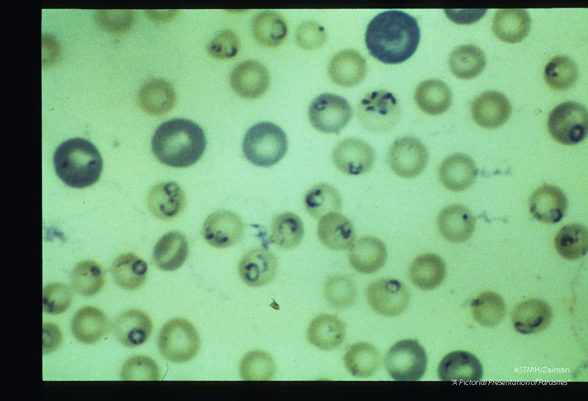 Giemsa stained slides from a fatal case on Fire Island, N. Y., (1982). The parasitemia is high for human babesiosis. Budding, multiply-infected erythrocytes, tetrad formation, band forms, reticulocytosis and clumping of extracellular parasites may be seen.