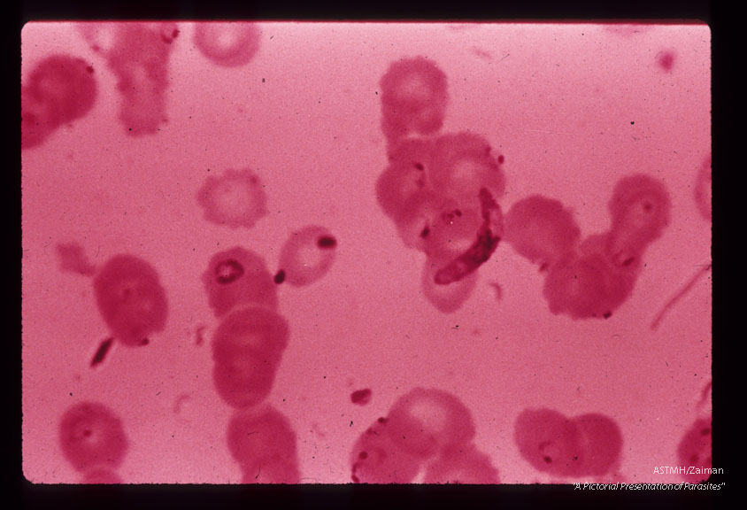 A 69 year old white male received 10 pints of blood shortly before,  during and after gastrectomy for a   benign gastric ulcer.    One of the donors,  a previously infected veteran of the Viet Nam war, registered at the blood bank under a false name and addrer Approximately four weeks after the surgery the patient developed a fatal case of falciparum malaria.  Blood smear showing rings and gametocyte.