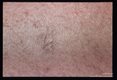 Healing skin lesion.