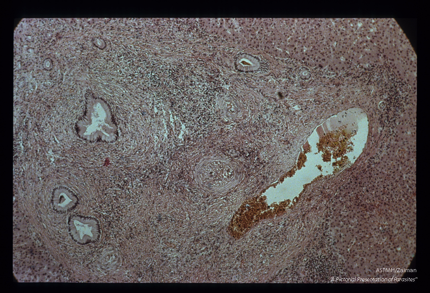 Portal fibrosis. Case of pipestem fibrosis (see slide 24).