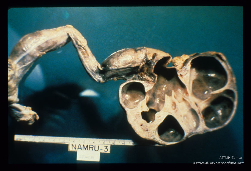 Hydroureter and hydronephrosis, fresh and formalin fixed specimens.