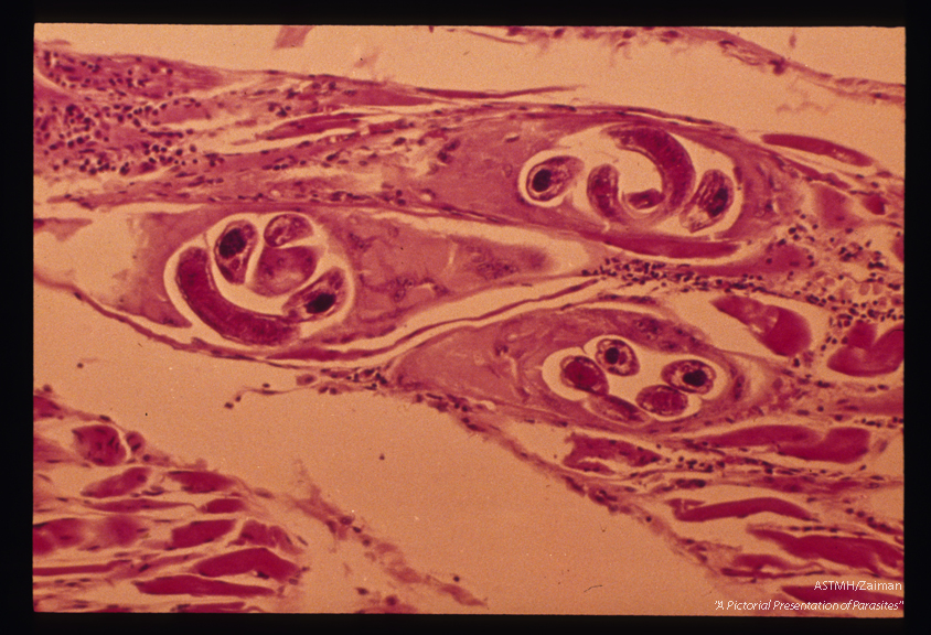 Human case. Three larvae are seen in three separate cysts. There is a marked inflammatory reaction in the surrounding muscle.