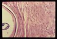 High power view showing microfilaria in nodule of fibrotic tissue adjacent to adult.
