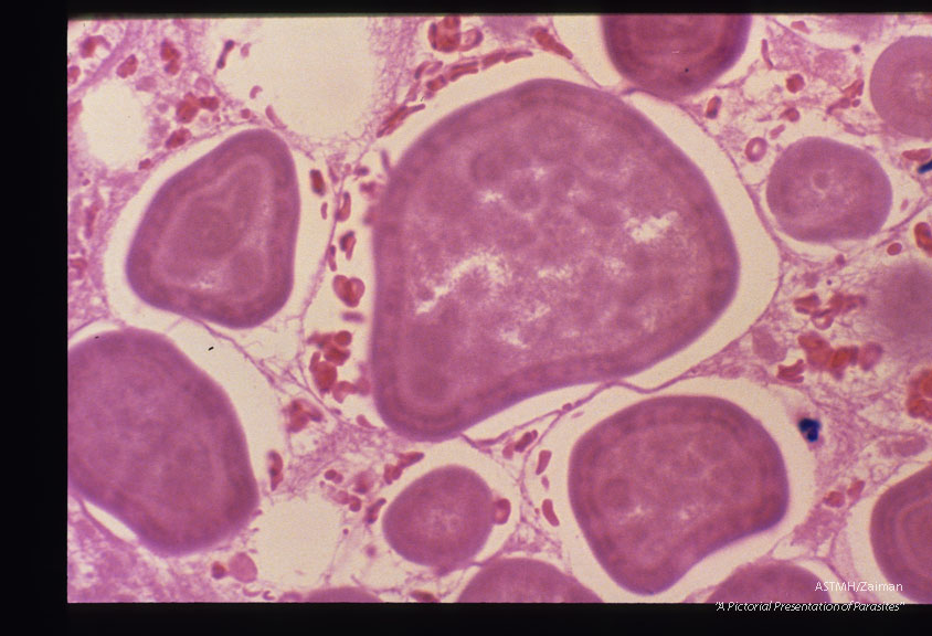 These slides are from a second such case. Reference Amer. Journ. Surg. Path. '11(8): 598-605,1987.