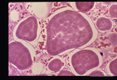 These slides are from a second such case. Reference Amer. Journ. Surg. Path. '11(8): 598-605,1987.