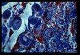 Costa Rica. This slide shows invasion of colon wall with associated hemorrhage. Red blood cells appear red with this Mallory Trichrome Stain.