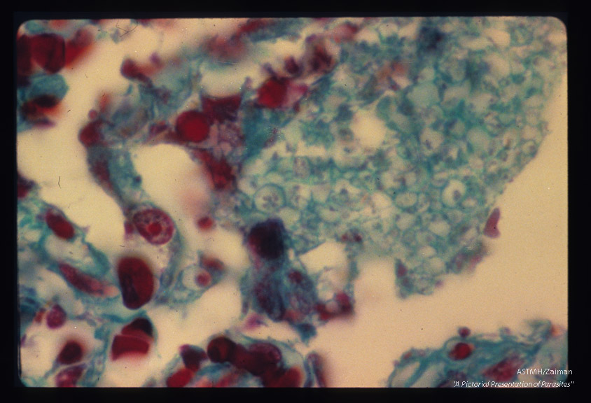 Pneumonia. Oil immersion views of alveoli stained by the Wheatly modification of trichrome for stools showing numerous parasites within "honeycomb" material. Parasitic nuclear material and limiting membranes stain well. There is active proliferation of alveolar macrophages and evidence of phagocytosis.