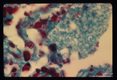 Pneumonia. Oil immersion views of alveoli stained by the Wheatly modification of trichrome for stools showing numerous parasites within 