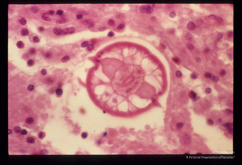 Larva and inflammation in corpus callosum of an infected rabbit.