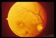 In human eye. Relationship to optic disc and macula shown,