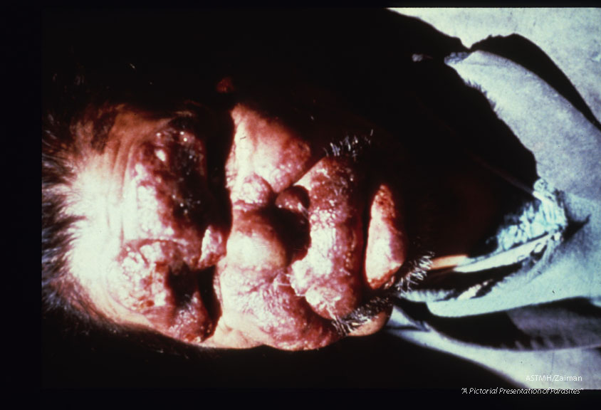 Diffuse anergic cutaneous leishmaniasis. Patient is a 68 year old laborer whose disease started as a papule on the side of the nose plus others on the extremities about 15 years earlier.