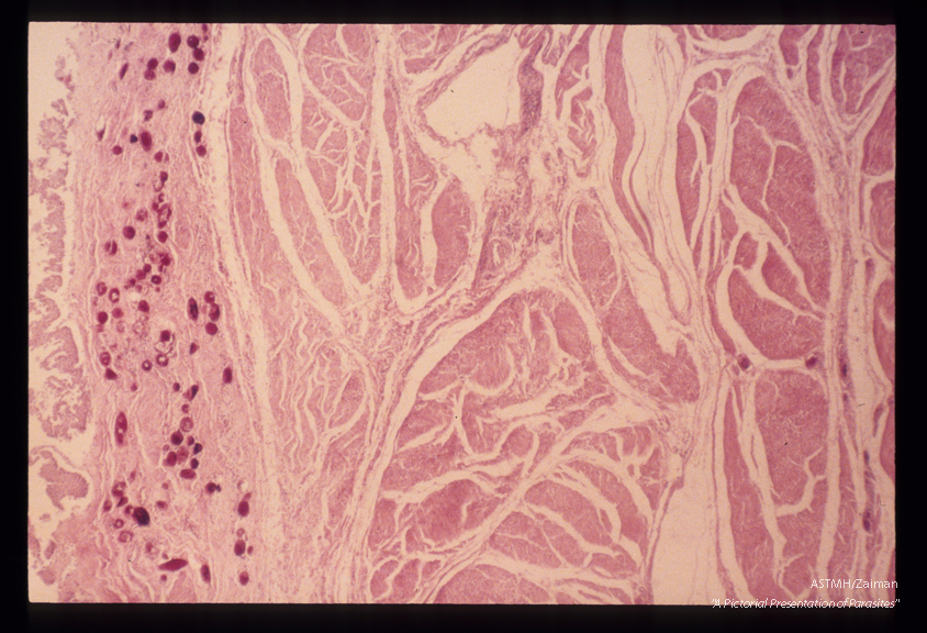 Eggs in human urinary bladder. The calcified eggs are seen below the bladder epithelium. There is marked hypertrophy of the bladder musculature and some epithelium is lost at the upper right.