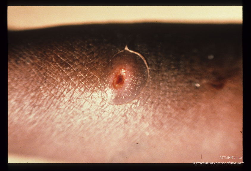 Ulcer from which a maggot was removed. Liberia.