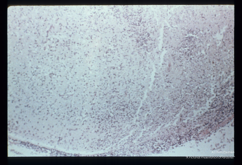 Encephalomyelitis.