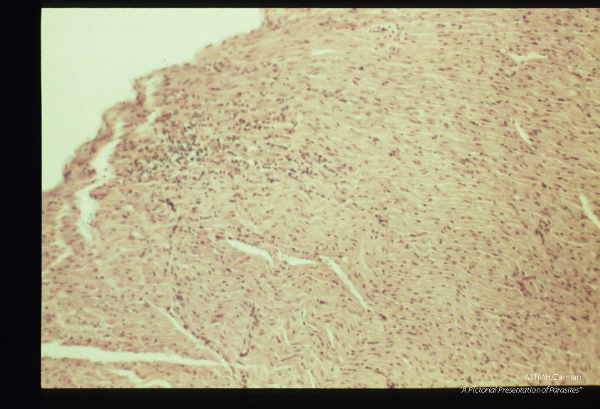 Focal myocardial lesions at low and high powers. Experimental trichinous myocarditis in rats.