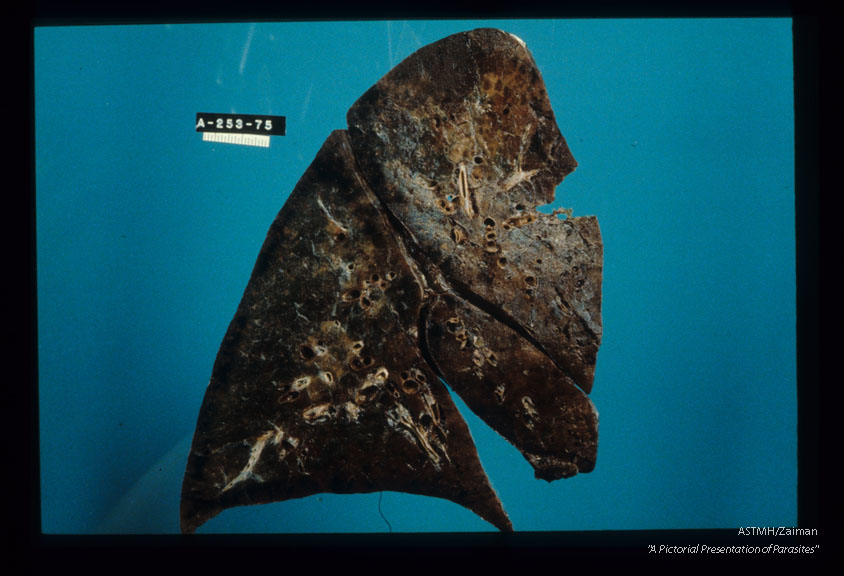 Autopsied human lung showing hemorrhagic pneumonia and the etiologic agent, a mesocercaria in the patient's lung.