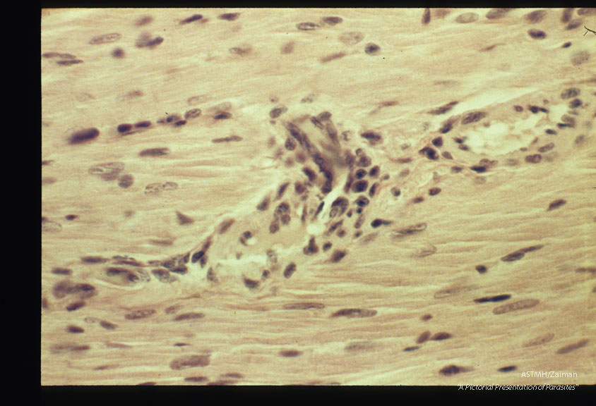 Perivascular inflammatory lesions. Experimental trichinous myocarditis in rats.