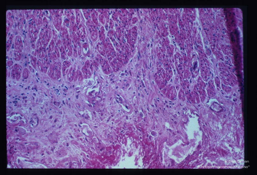 Chronic inflammatory response in region of bowel ulcer.