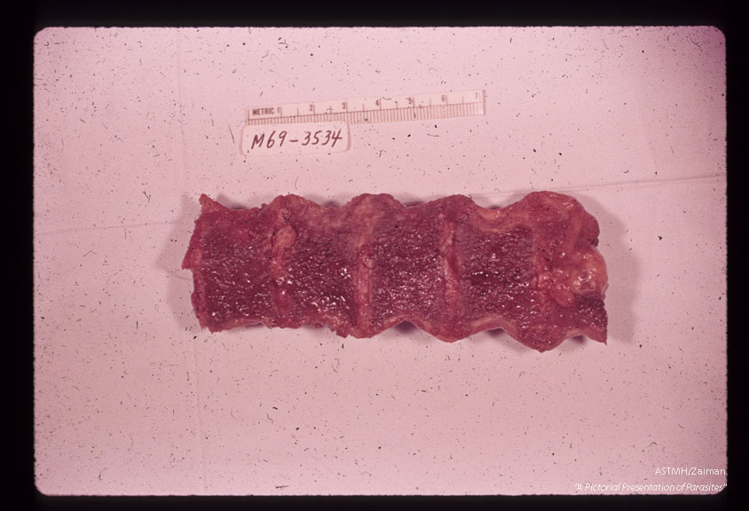 A 69 year old white male received 10 pints of blood shortly before,  during and after gastrectomy for a   benign gastric ulcer.    One of the donors,  a previously infected veteran of the Viet Nam war, registered at the blood bank under a false name and addrer Approximately four weeks after the surgery the patient developed a fatal case of falciparum malaria.  Deeply stained marrow indicative of pigment deposition, gross specimen.