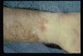 Lesion at wrist.