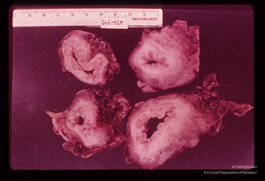 Same patient. Multiple cross sections showing extensive fibrosis associated with egg burdens of 110, 000 (S. mansoni) and 1,500 (S. haematobium) per gram of host tissue.