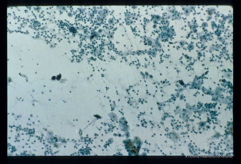 Multiple Pap smear fields from the cervix of the same patient. Various magnifications.