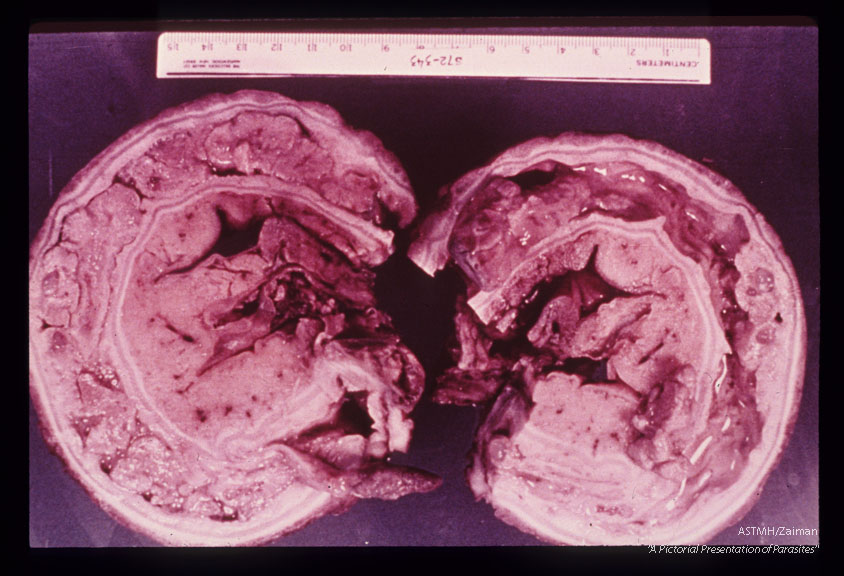 Surgically resected colon from 18 year old Egyptian male showing lumen filled with multiple polyps. Wall of colon was also fibrotic. Discolored by formalin fixation prior to photography.