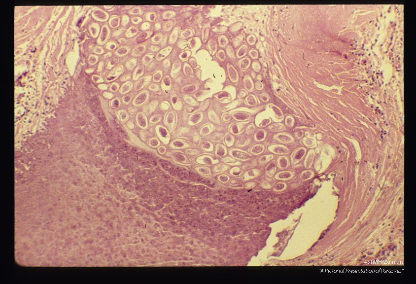 Ovarian enterobiasis.